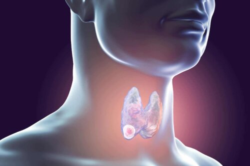 Cancer de la thyroïde. 