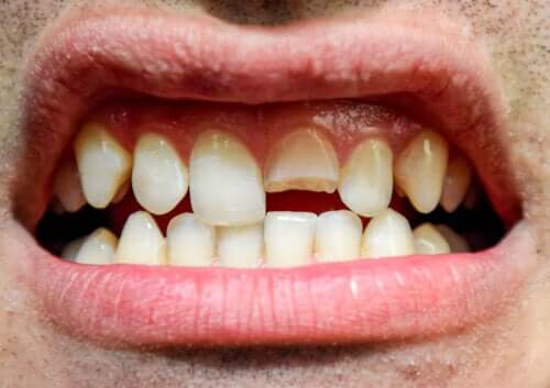 Traumatisme dentaire : de quoi s'agit-il et quels types existe-t-il ?
