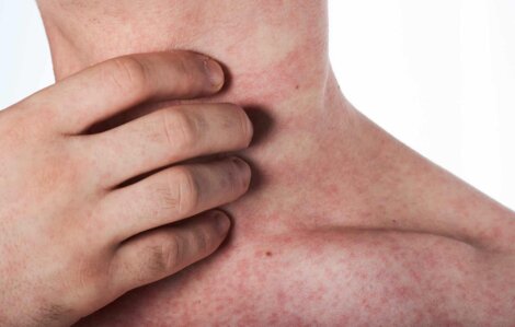 Allergie à la cimicifuga.