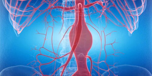 Schéma d'un anévrisme.