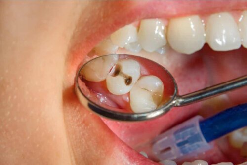 Une carie dans la bouche d'un enfant.