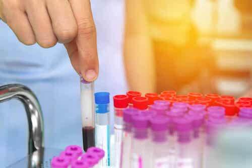 Diagnostic de la néphropathie à IgA.