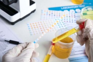 Néphropathie membraneuse : causes et caractéristiques