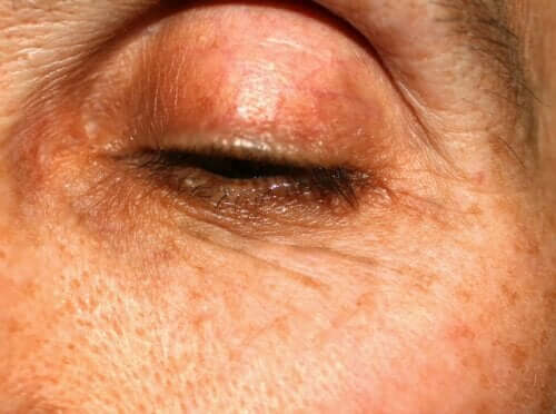 Meibomite : causes, symptômes et traitements