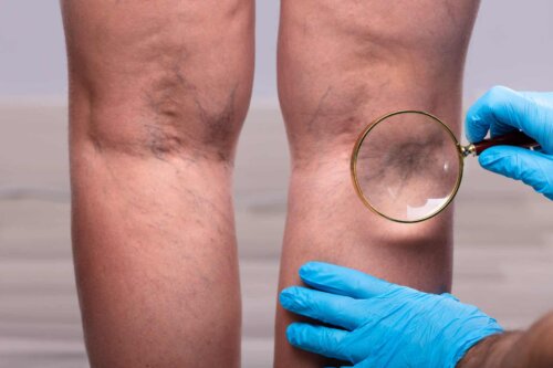 Œdèmes et varices aux jambes.