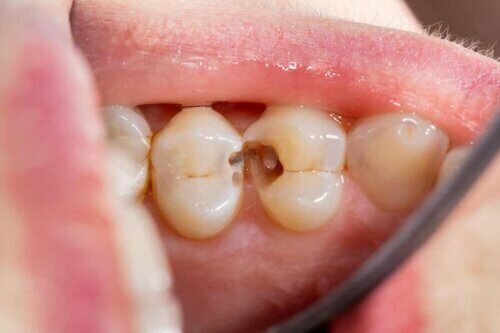 Un patient avec des caries.