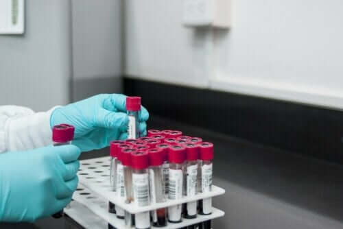 Test rapide de la réagine plasmatique pour le diagnostic de la syphilis