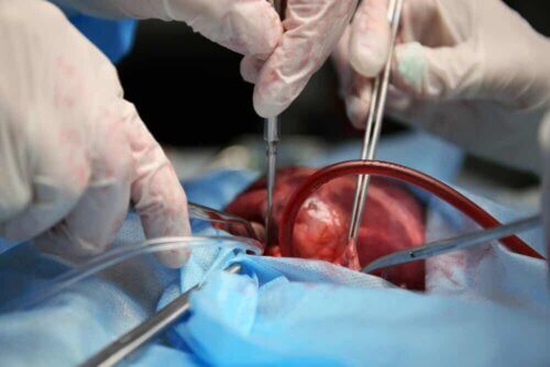 Une transplantation cardiaque.