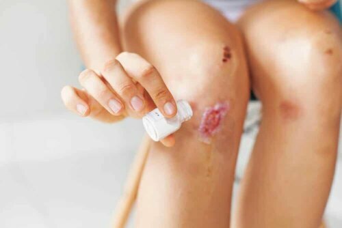 La cicatrisation d'une blessure avec de la racine d'angélique.