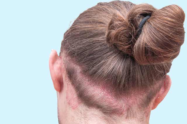 Une femme souffrant de dermatite séborrhéique.