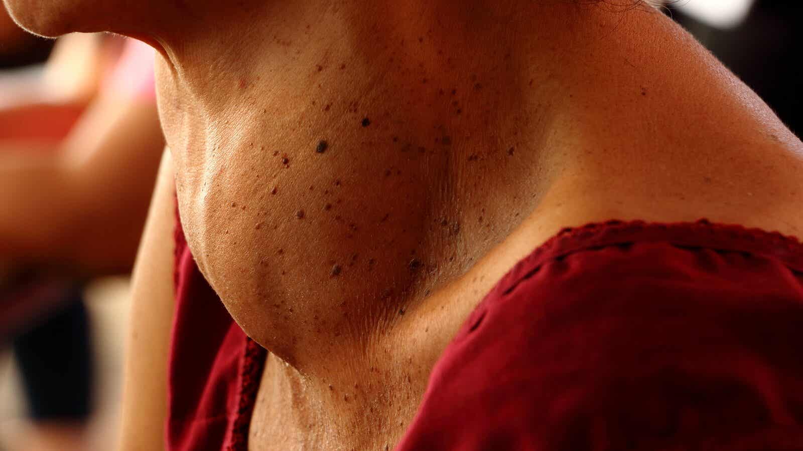 Le goitre est un élargissement de la glande thyroïde.