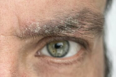 Pellicules de sourcils : pourquoi apparaissent-elles et comment s'en débarrasser ?