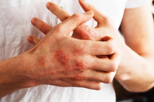 Du psoriasis sur les mains.