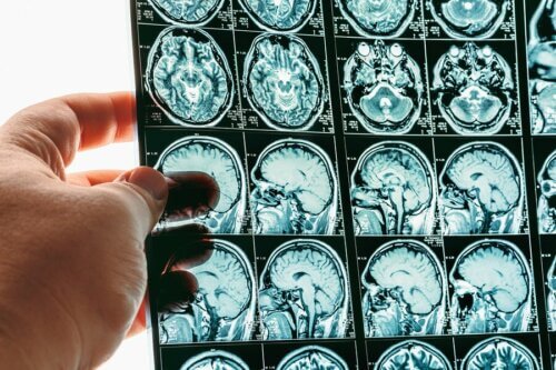 Engagement cérébral (hernie cérébrale) : symptômes et causes