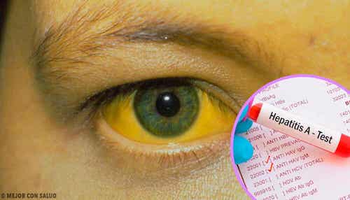 Maladies infectieuses : l'hépatite A.