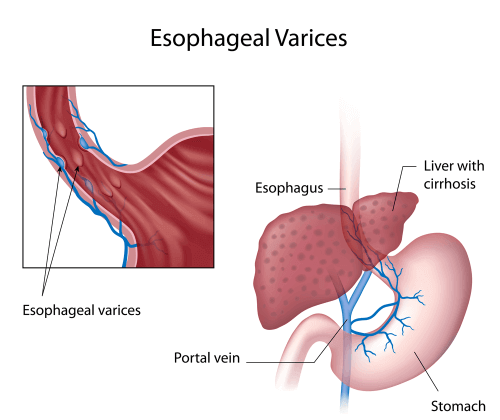 Les symptômes des varices œsophagiennes