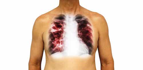 Les maladies infectieuses : la tuberculose.