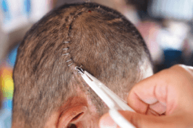 Qu'est-ce qu'une craniotomie et quand est-elle nécessaire ?