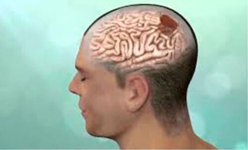 Une tumeur cérébrale.