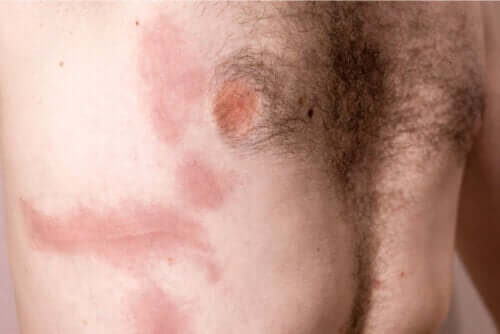 Contusion costale : causes, symptômes et soins