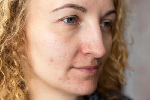 Une femme souffrant de mélasma sur le visage.