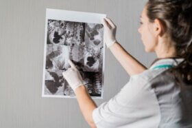 Perforation gastro-intestinale : causes, symptômes et traitements