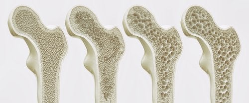 Ostéoporose, quelles sont ses complications ?