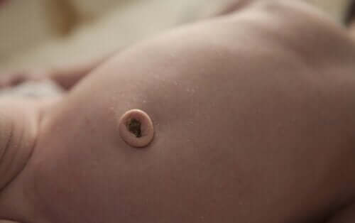 Granulome ombilical : causes et traitement