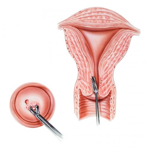 Quand faut-il faire une biopsie du col de l’utérus ?