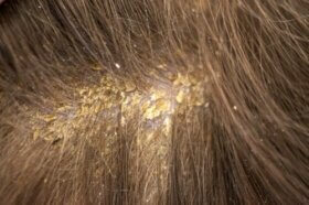 Croûtes sur le cuir chevelu : 13 causes possibles