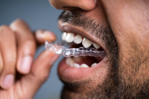 13 doutes à lever avant de choisir l'orthodontie invisible