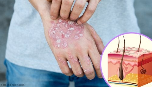 Psoriasis : causes, symptômes, diagnostic et traitement