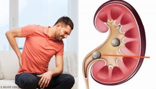 Qu'est-ce que la lithiase rénale ?