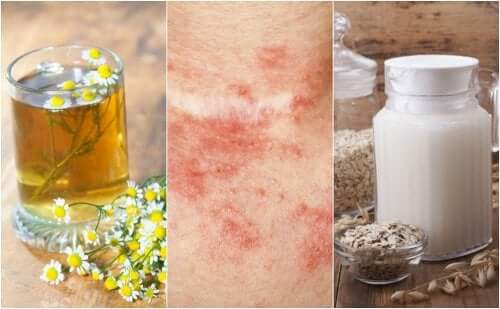 5 remèdes maison pour traiter la dermatite de contact