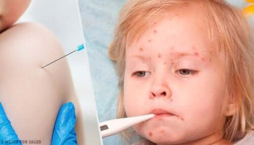 Rougeole : causes, traitement et prévention