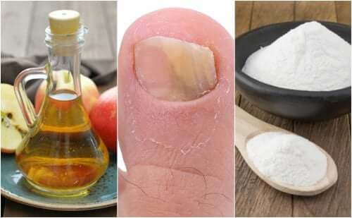 Combattez les mycoses des ongles avec du vinaigre de cidre de pomme et du bicarbonate de soude