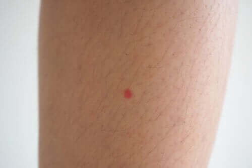 Taches rouges sur les jambes : à quoi sont-elles dues et que faire ?