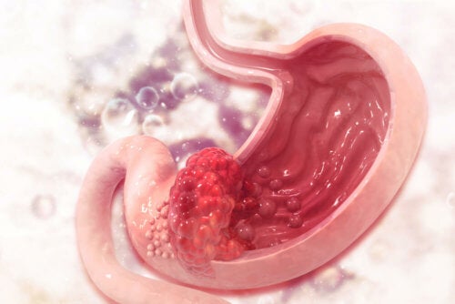 Ulcère gastrique : causes, symptômes et traitement