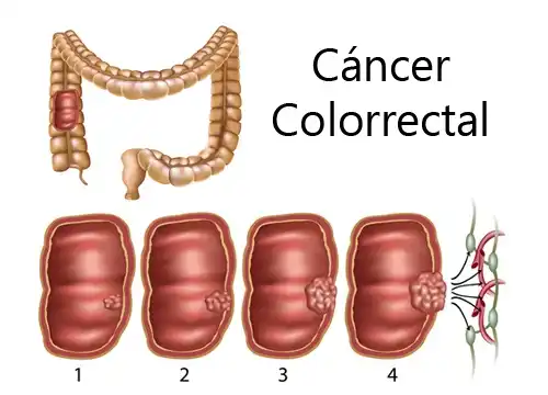 Cancer colorectal.