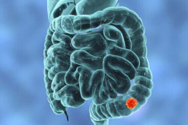 7 symptômes du cancer colorectal chez les femmes