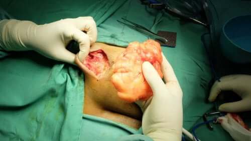 Lipome abdominal : symptômes et traitement