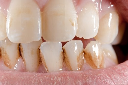 Comment éliminer naturellement le tartre des dents ?