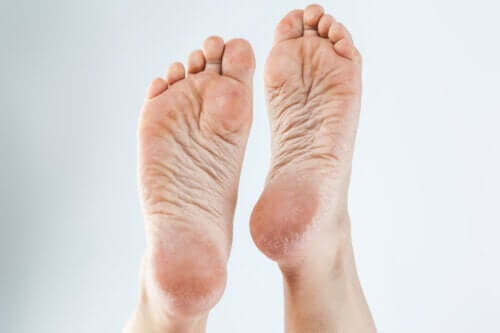 3 crèmes naturelles pour éliminer les callosités des pieds