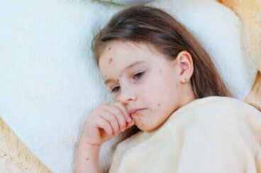 Variole : l'origine du vaccin