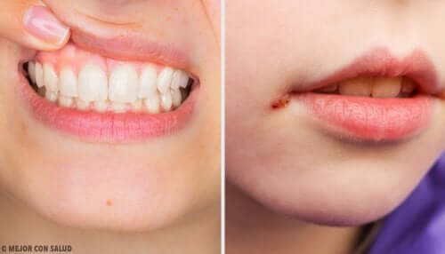 Gencives blanches : quelles en sont les causes ?