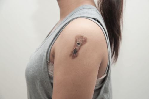 Carcinome épidermoïde : causes, symptômes et traitements