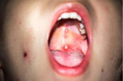 Gingivostomatite chez l'enfant : qu'est-ce que c'est et comment agir ?