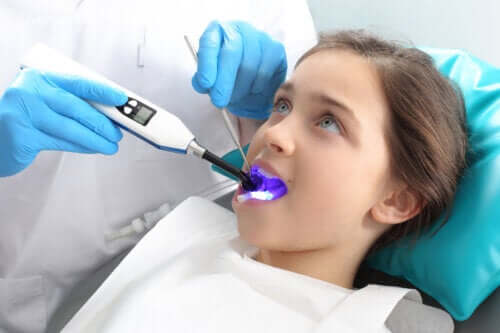 Que sont les scellants dentaires et à quoi servent-ils ?