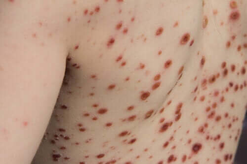 Variole du singe : causes, symptômes, diagnostic et traitement