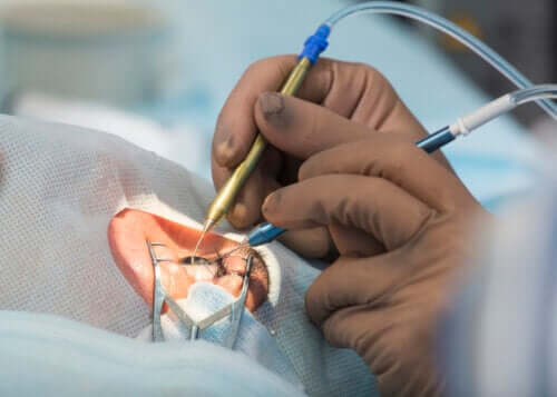 Chirurgie de la cataracte : 8 effets secondaires